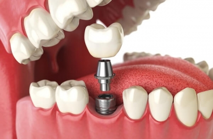 Trồng răng Implant 5S